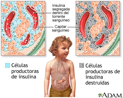 Ilustración de cómo la diabetes afecta el cuerpo y el metabolismo de la glucosa.